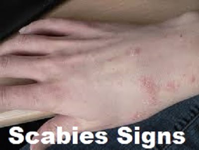 scabies infection control - Jopestkil Kenya Fumigation and Pest Control ...